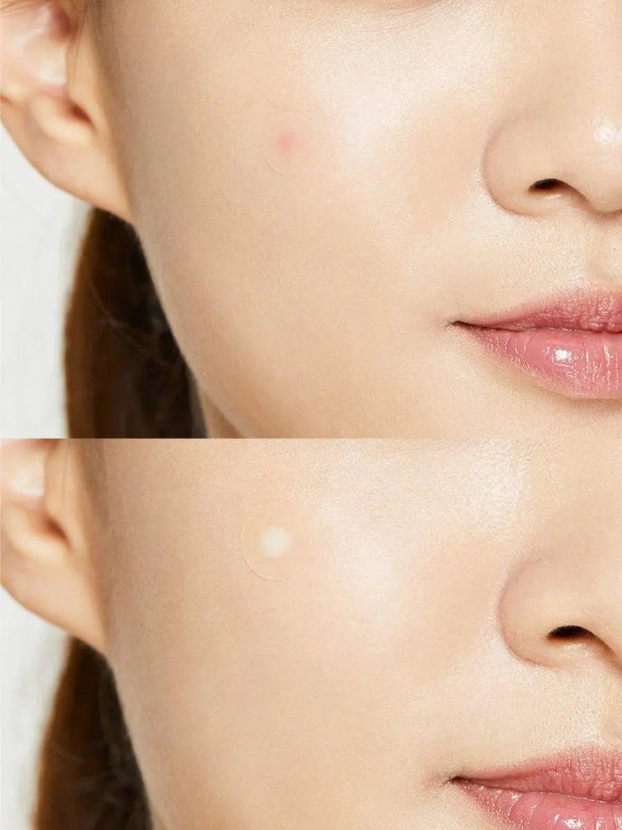 Acne pimple Master 24 patches Cosrx